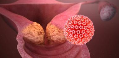 ВОПРОСЫ И ОТВЕТЫ О ВАКЦИНАЦИИ ПРОТИВ ИНФЕКЦИИ, ВЫЗВАННОЙ ВИРУСОМ ПАПИЛЛОМЫ ЧЕЛОВЕКА