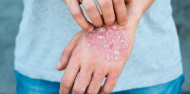 Профилактика псориаза