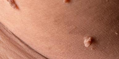 Профилактика ВИРУСА ПАПИЛЛОМЫ ЧЕЛОВЕКА (ВПЧ)